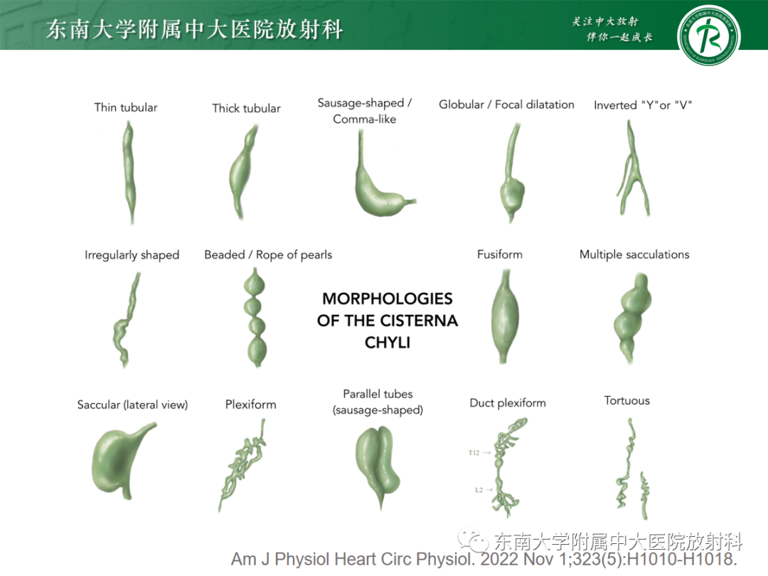 影像PPT - 【PPT】扩大乳糜池的影像表现及其鉴别诊断-10 影像PPT - 【PPT】扩大乳糜池的影像表现及其鉴别诊断-10