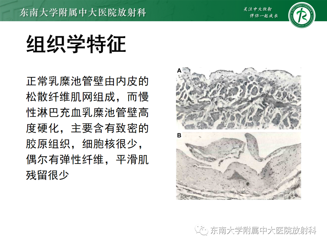 影像PPT - 【PPT】扩大乳糜池的影像表现及其鉴别诊断-11 影像PPT - 【PPT】扩大乳糜池的影像表现及其鉴别诊断-11