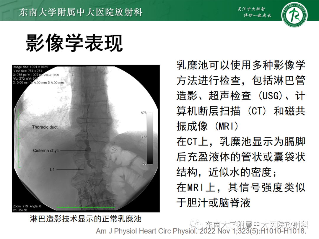 影像PPT - 【PPT】扩大乳糜池的影像表现及其鉴别诊断-12 影像PPT - 【PPT】扩大乳糜池的影像表现及其鉴别诊断-12
