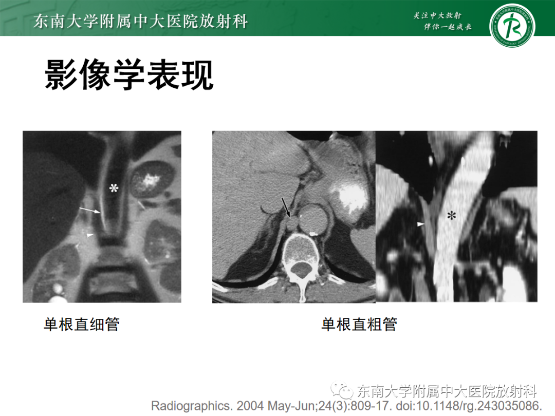 影像PPT - 【PPT】扩大乳糜池的影像表现及其鉴别诊断-14 影像PPT - 【PPT】扩大乳糜池的影像表现及其鉴别诊断-14