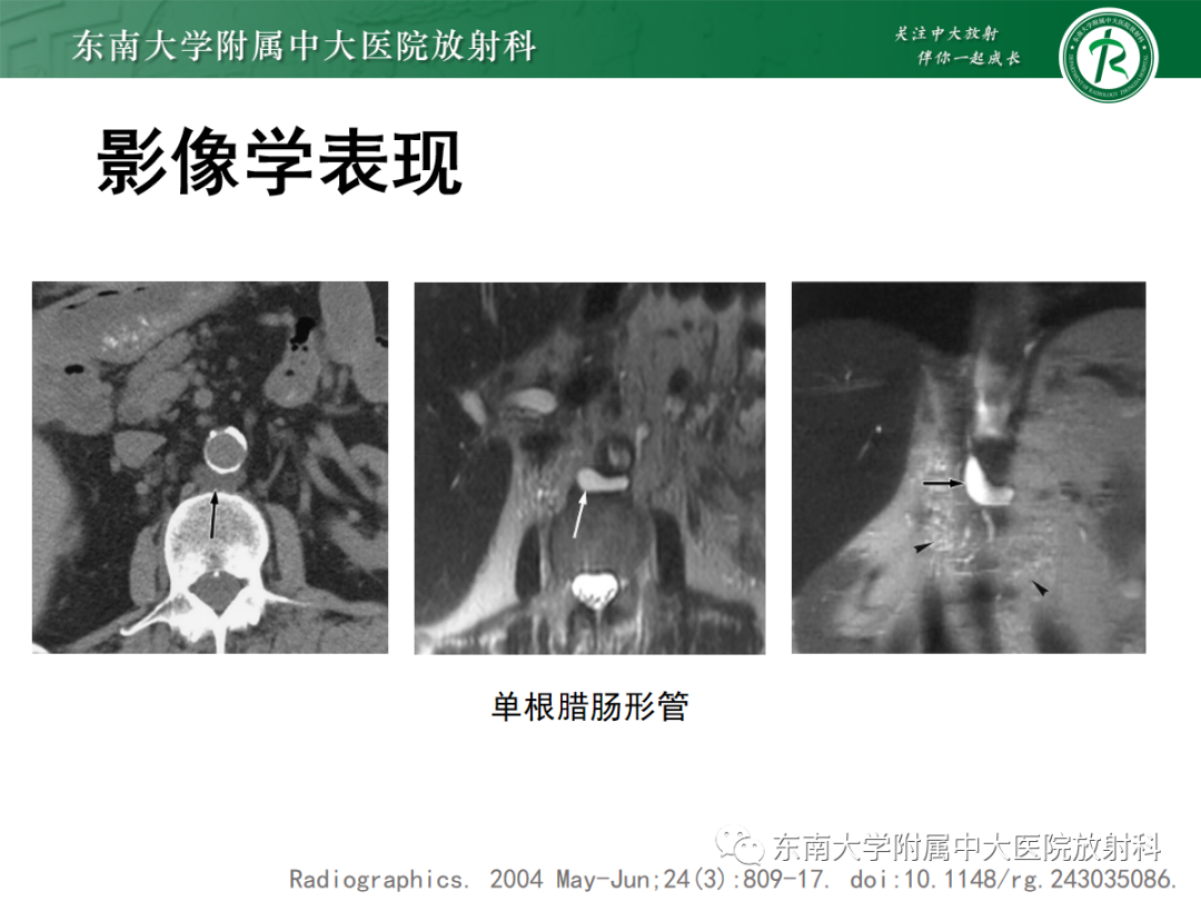 影像PPT - 【PPT】扩大乳糜池的影像表现及其鉴别诊断-15 影像PPT - 【PPT】扩大乳糜池的影像表现及其鉴别诊断-15