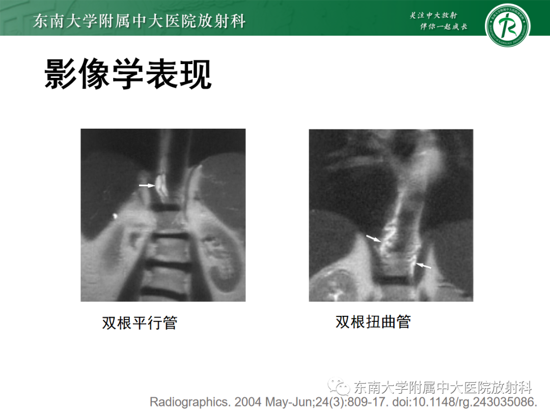 影像PPT - 【PPT】扩大乳糜池的影像表现及其鉴别诊断-16 影像PPT - 【PPT】扩大乳糜池的影像表现及其鉴别诊断-16