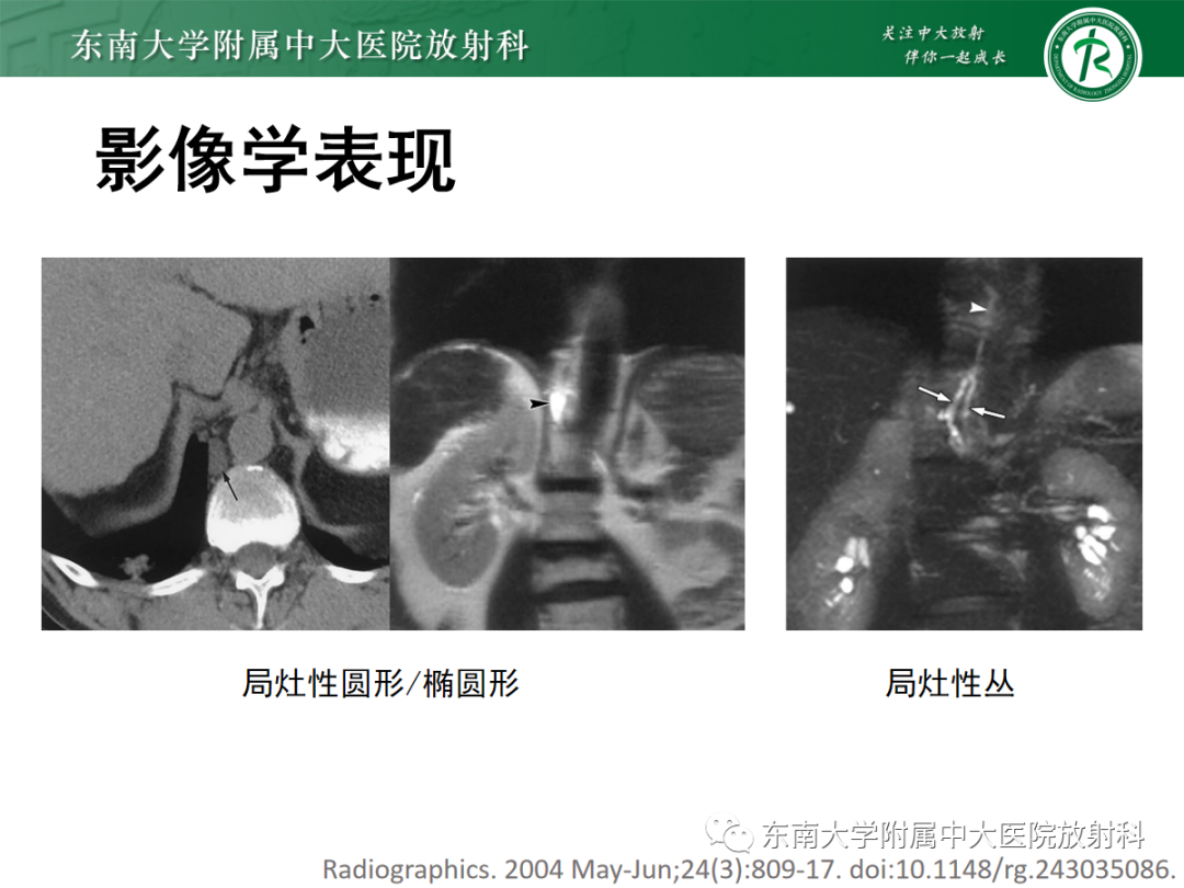 影像PPT - 【PPT】扩大乳糜池的影像表现及其鉴别诊断-17 影像PPT - 【PPT】扩大乳糜池的影像表现及其鉴别诊断-17