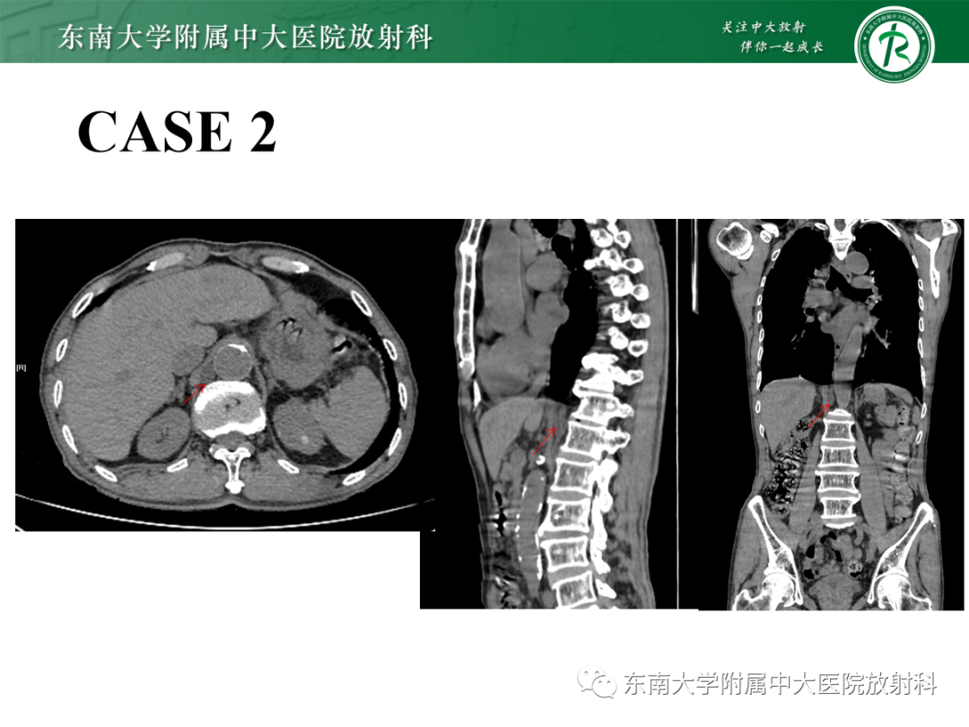 影像PPT - 【PPT】扩大乳糜池的影像表现及其鉴别诊断-20 影像PPT - 【PPT】扩大乳糜池的影像表现及其鉴别诊断-20