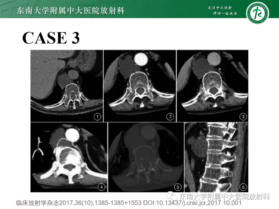 影像PPT - 【PPT】扩大乳糜池的影像表现及其鉴别诊断-21 影像PPT - 【PPT】扩大乳糜池的影像表现及其鉴别诊断-21