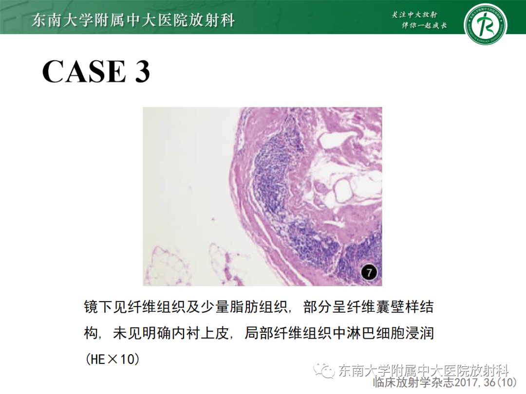 影像PPT - 【PPT】扩大乳糜池的影像表现及其鉴别诊断-22 影像PPT - 【PPT】扩大乳糜池的影像表现及其鉴别诊断-22