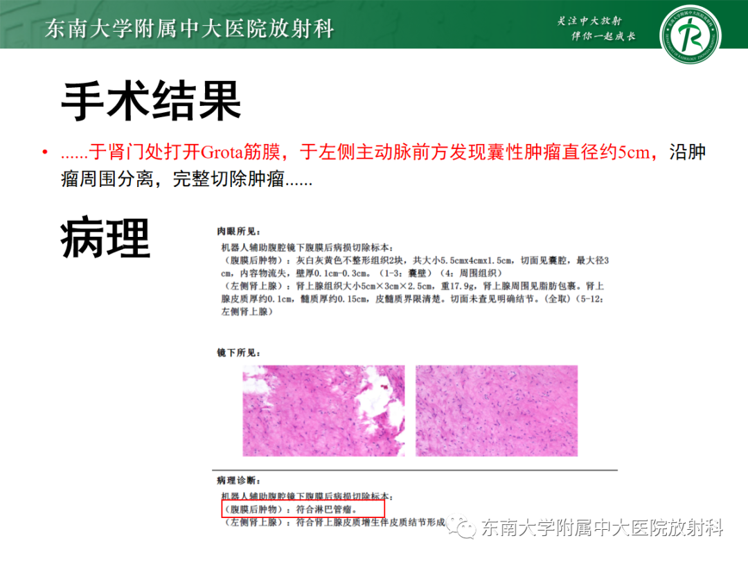 影像PPT - 【PPT】扩大乳糜池的影像表现及其鉴别诊断-28 影像PPT - 【PPT】扩大乳糜池的影像表现及其鉴别诊断-28