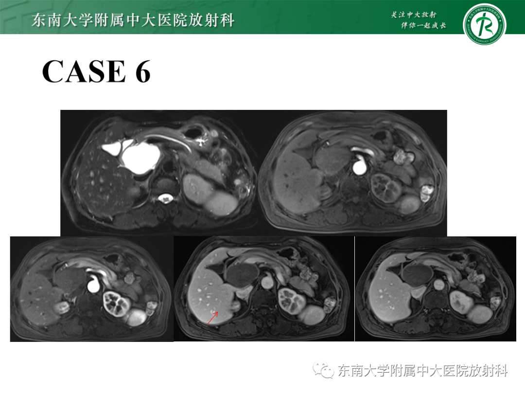 影像PPT - 【PPT】扩大乳糜池的影像表现及其鉴别诊断-30 影像PPT - 【PPT】扩大乳糜池的影像表现及其鉴别诊断-30