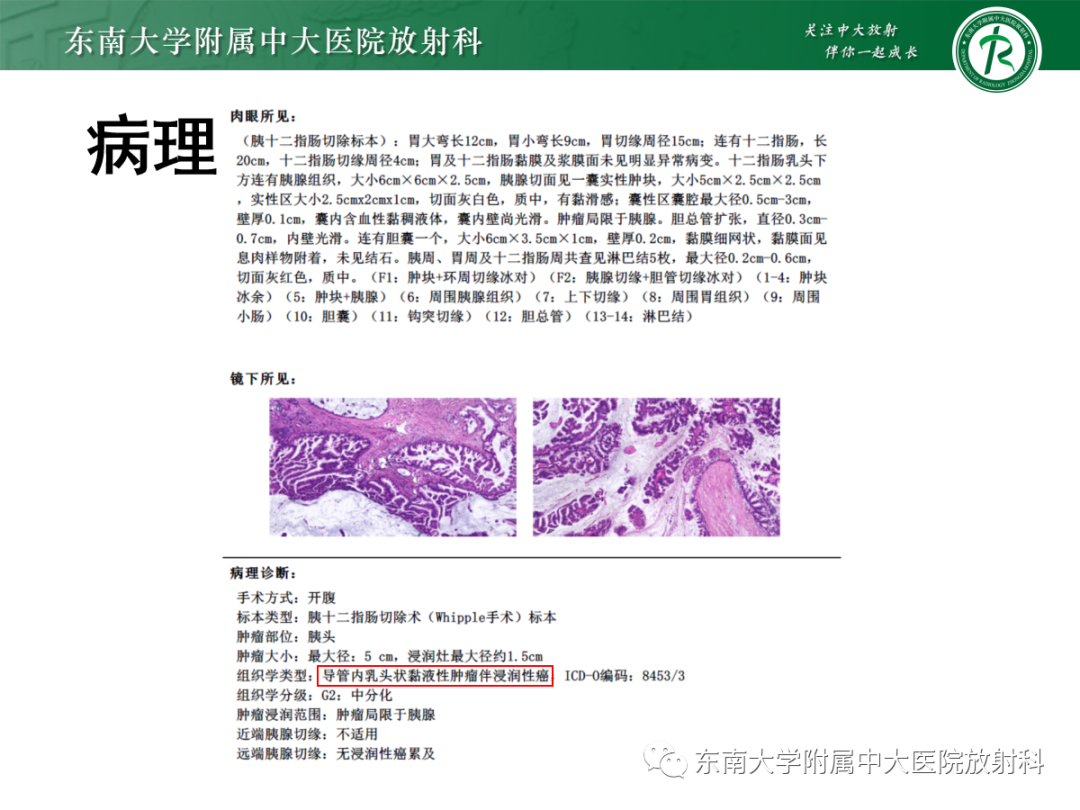 影像PPT - 【PPT】扩大乳糜池的影像表现及其鉴别诊断-31 影像PPT - 【PPT】扩大乳糜池的影像表现及其鉴别诊断-31