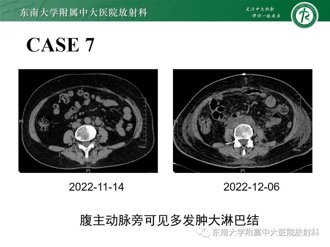 影像PPT - 【PPT】扩大乳糜池的影像表现及其鉴别诊断-33 影像PPT - 【PPT】扩大乳糜池的影像表现及其鉴别诊断-33