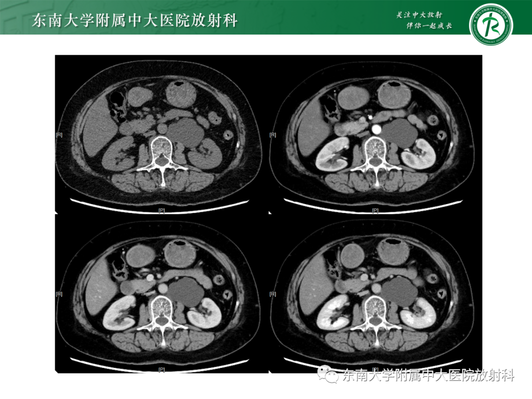 影像PPT - 【PPT】扩大乳糜池的影像表现及其鉴别诊断-27 影像PPT - 【PPT】扩大乳糜池的影像表现及其鉴别诊断-27