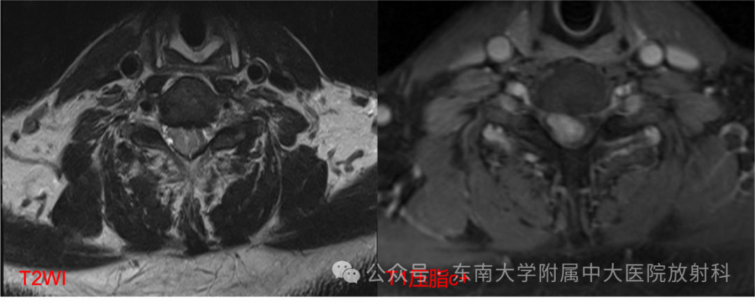 影像PPT - 【PPT】脊髓罕见占位性病变-2 影像PPT - 【PPT】脊髓罕见占位性病变-2