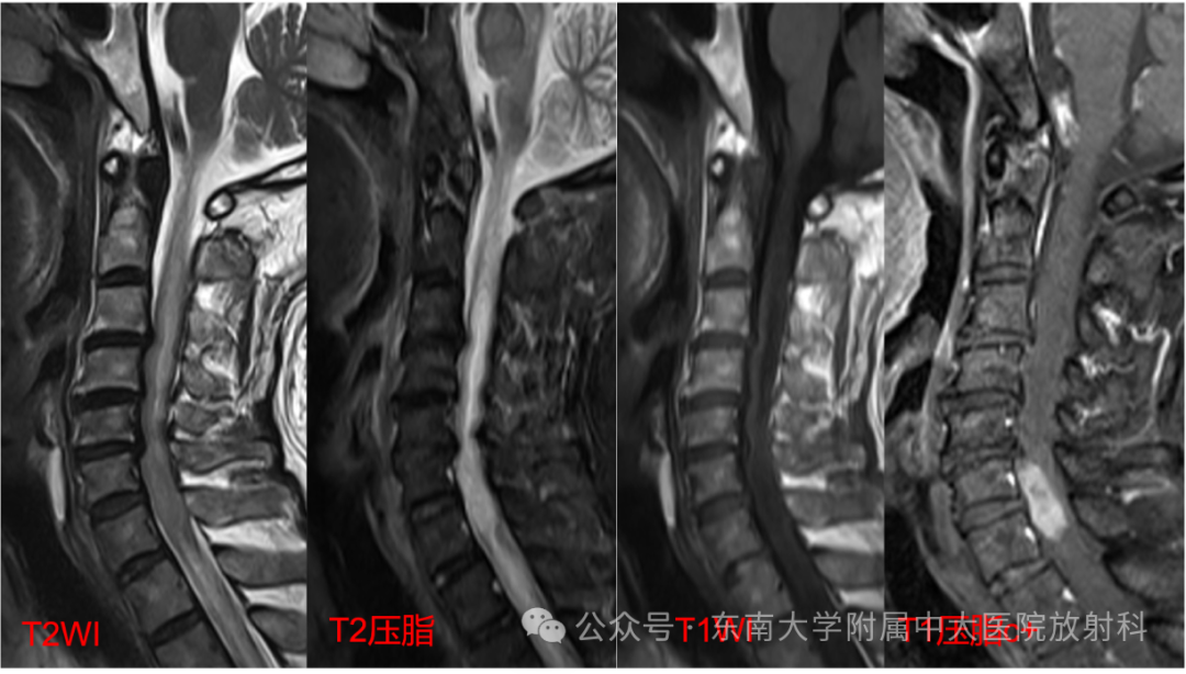 影像PPT - 【PPT】脊髓罕见占位性病变-1 影像PPT - 【PPT】脊髓罕见占位性病变-1