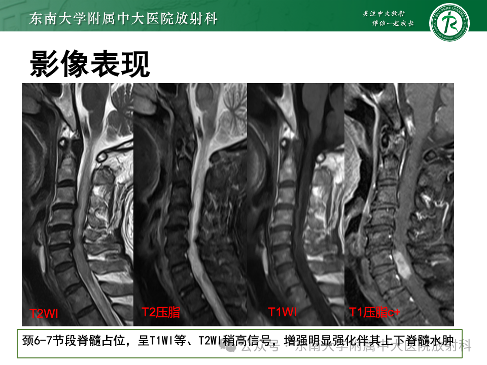 影像PPT - 【PPT】脊髓罕见占位性病变-6 影像PPT - 【PPT】脊髓罕见占位性病变-6