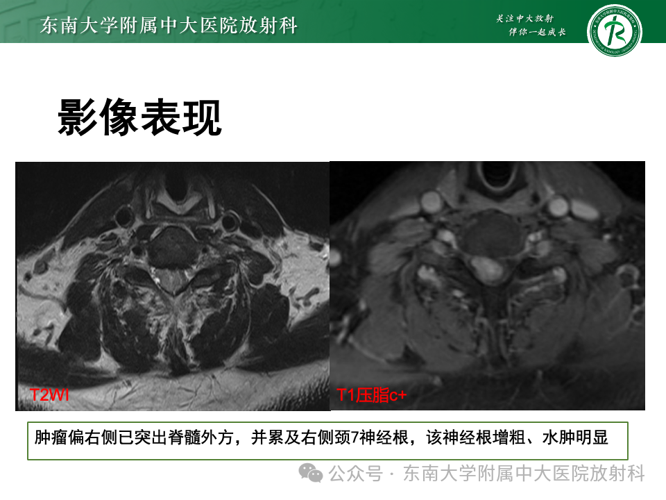影像PPT - 【PPT】脊髓罕见占位性病变-7 影像PPT - 【PPT】脊髓罕见占位性病变-7