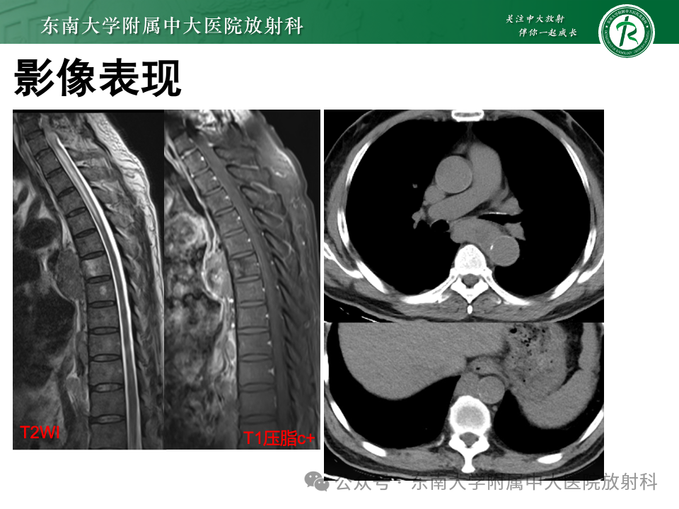 影像PPT - 【PPT】脊髓罕见占位性病变-8 影像PPT - 【PPT】脊髓罕见占位性病变-8