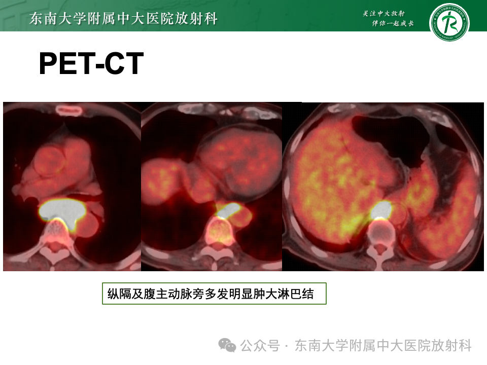 影像PPT - 【PPT】脊髓罕见占位性病变-9 影像PPT - 【PPT】脊髓罕见占位性病变-9