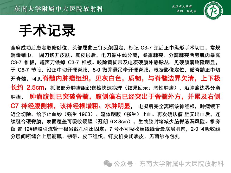 影像PPT - 【PPT】脊髓罕见占位性病变-10 影像PPT - 【PPT】脊髓罕见占位性病变-10