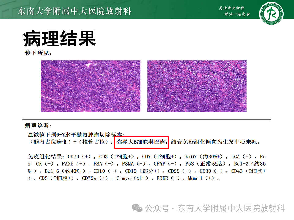 影像PPT - 【PPT】脊髓罕见占位性病变-11 影像PPT - 【PPT】脊髓罕见占位性病变-11