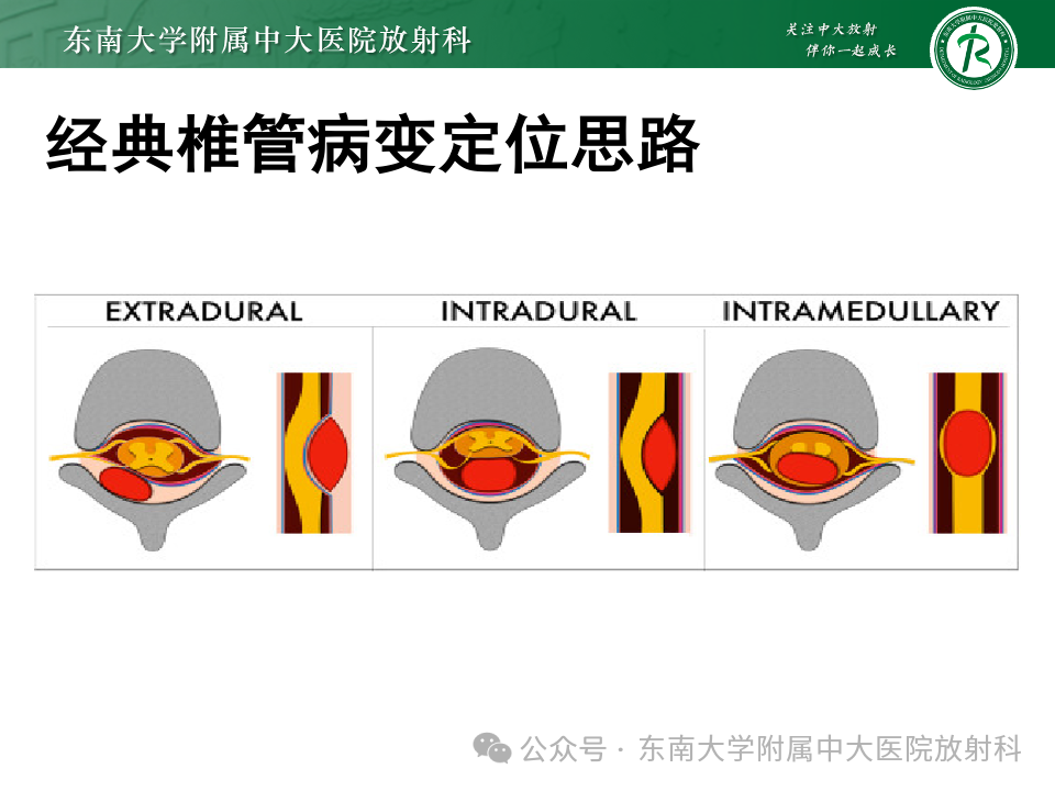 影像PPT - 【PPT】脊髓罕见占位性病变-15 影像PPT - 【PPT】脊髓罕见占位性病变-15