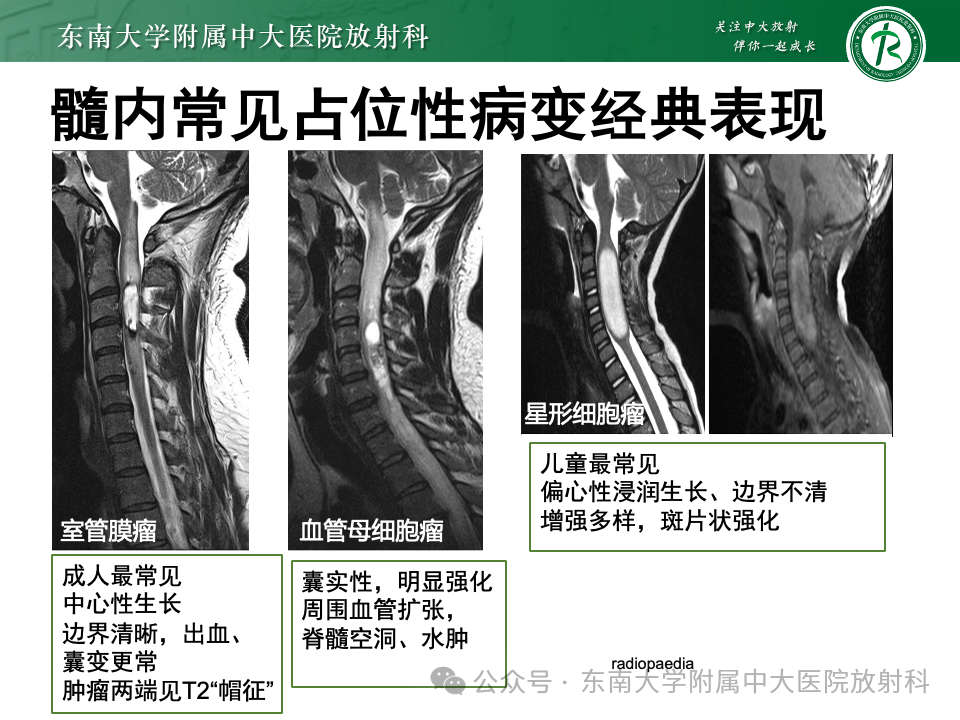 影像PPT - 【PPT】脊髓罕见占位性病变-16 影像PPT - 【PPT】脊髓罕见占位性病变-16