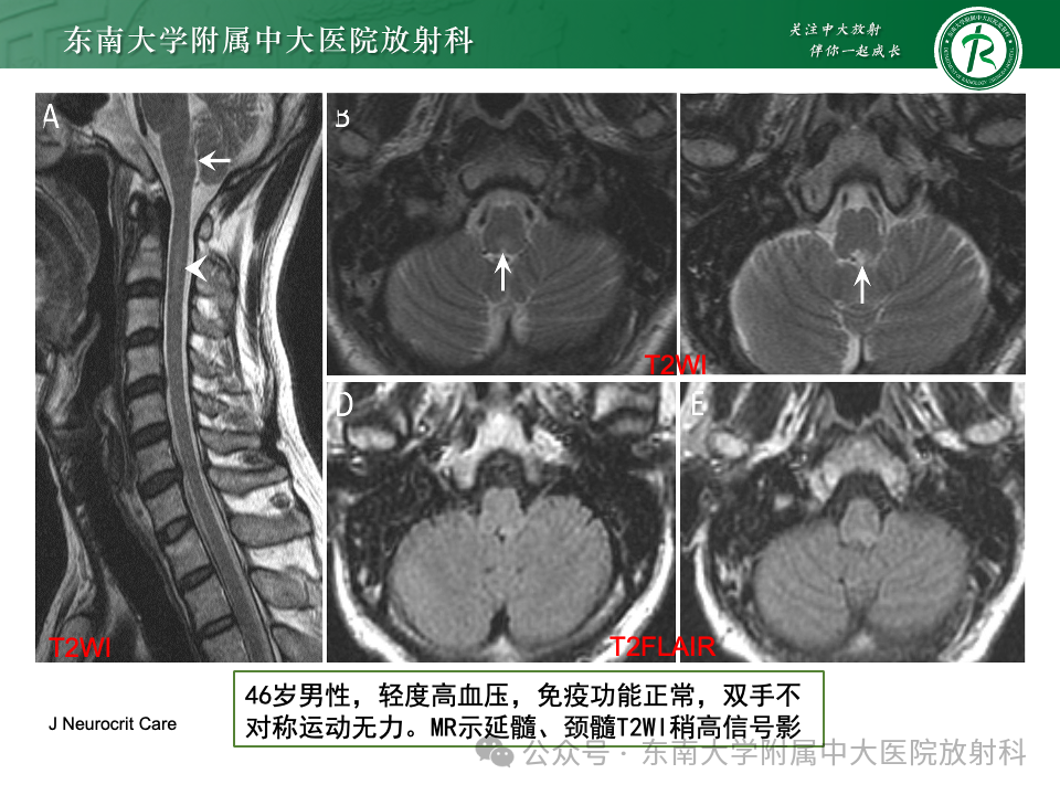 影像PPT - 【PPT】脊髓罕见占位性病变-22 影像PPT - 【PPT】脊髓罕见占位性病变-22