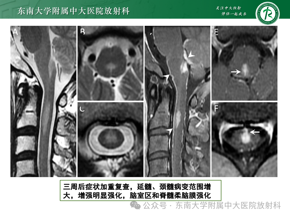 影像PPT - 【PPT】脊髓罕见占位性病变-23 影像PPT - 【PPT】脊髓罕见占位性病变-23
