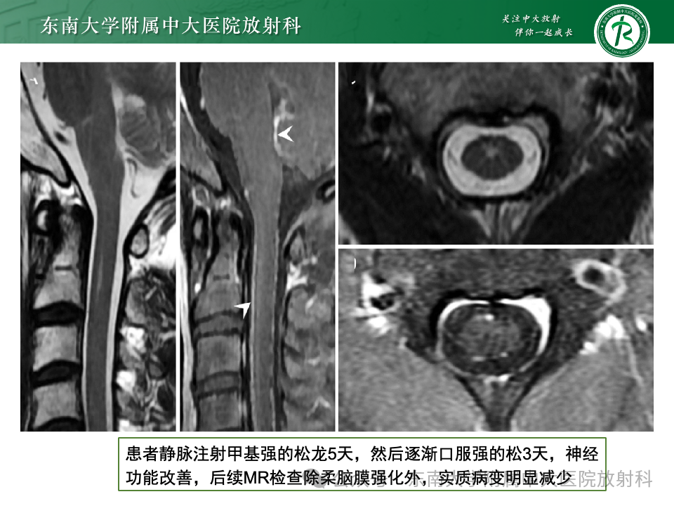 影像PPT - 【PPT】脊髓罕见占位性病变-25 影像PPT - 【PPT】脊髓罕见占位性病变-25