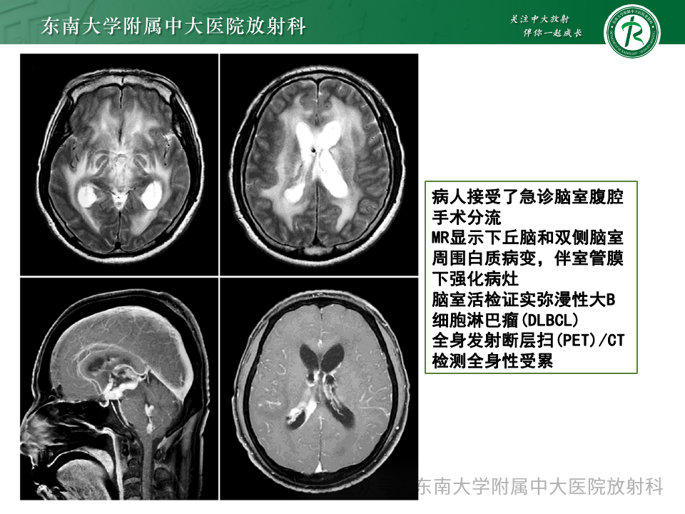 影像PPT - 【PPT】脊髓罕见占位性病变-27 影像PPT - 【PPT】脊髓罕见占位性病变-27