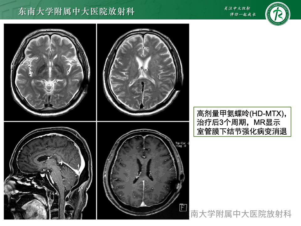 影像PPT - 【PPT】脊髓罕见占位性病变-28 影像PPT - 【PPT】脊髓罕见占位性病变-28