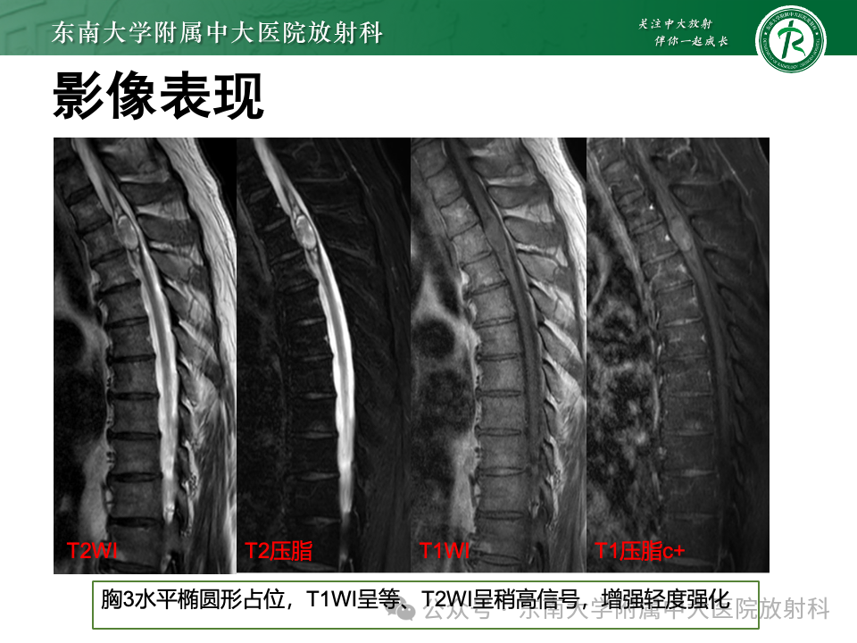 影像PPT - 【PPT】脊髓罕见占位性病变-31 影像PPT - 【PPT】脊髓罕见占位性病变-31