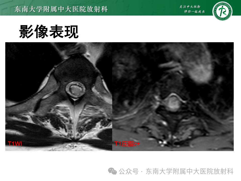 影像PPT - 【PPT】脊髓罕见占位性病变-32 影像PPT - 【PPT】脊髓罕见占位性病变-32