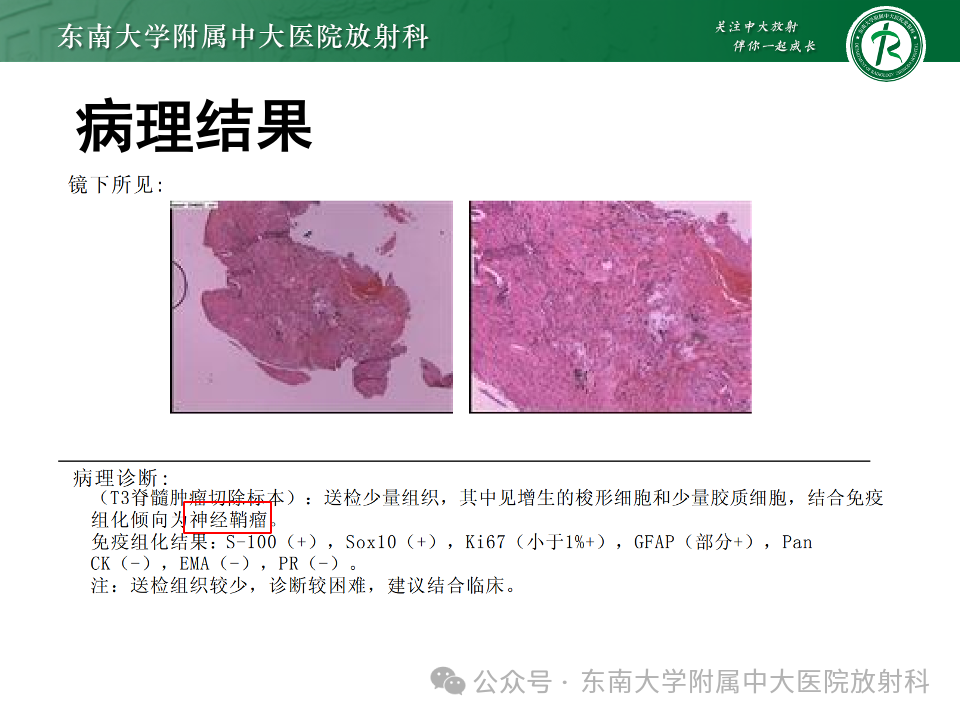 影像PPT - 【PPT】脊髓罕见占位性病变-34 影像PPT - 【PPT】脊髓罕见占位性病变-34