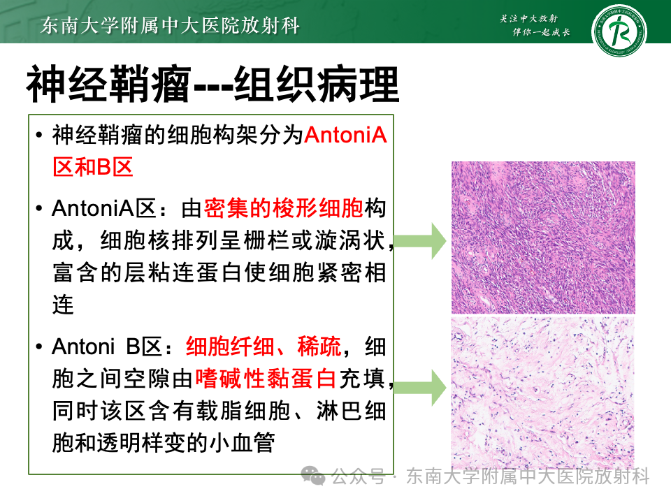 影像PPT - 【PPT】脊髓罕见占位性病变-38 影像PPT - 【PPT】脊髓罕见占位性病变-38