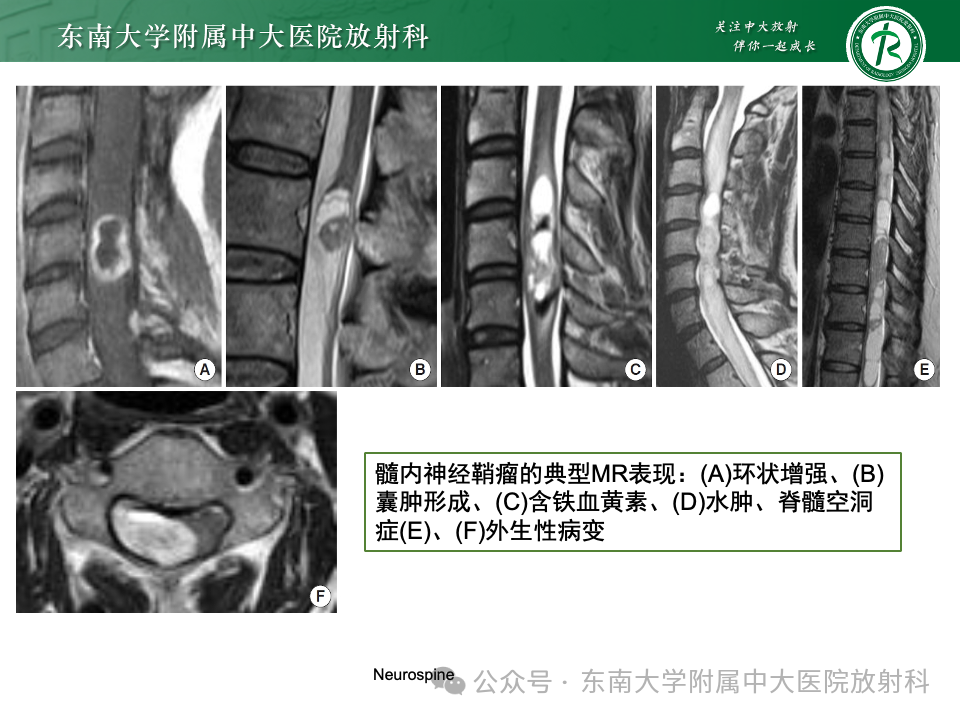 影像PPT - 【PPT】脊髓罕见占位性病变-41 影像PPT - 【PPT】脊髓罕见占位性病变-41