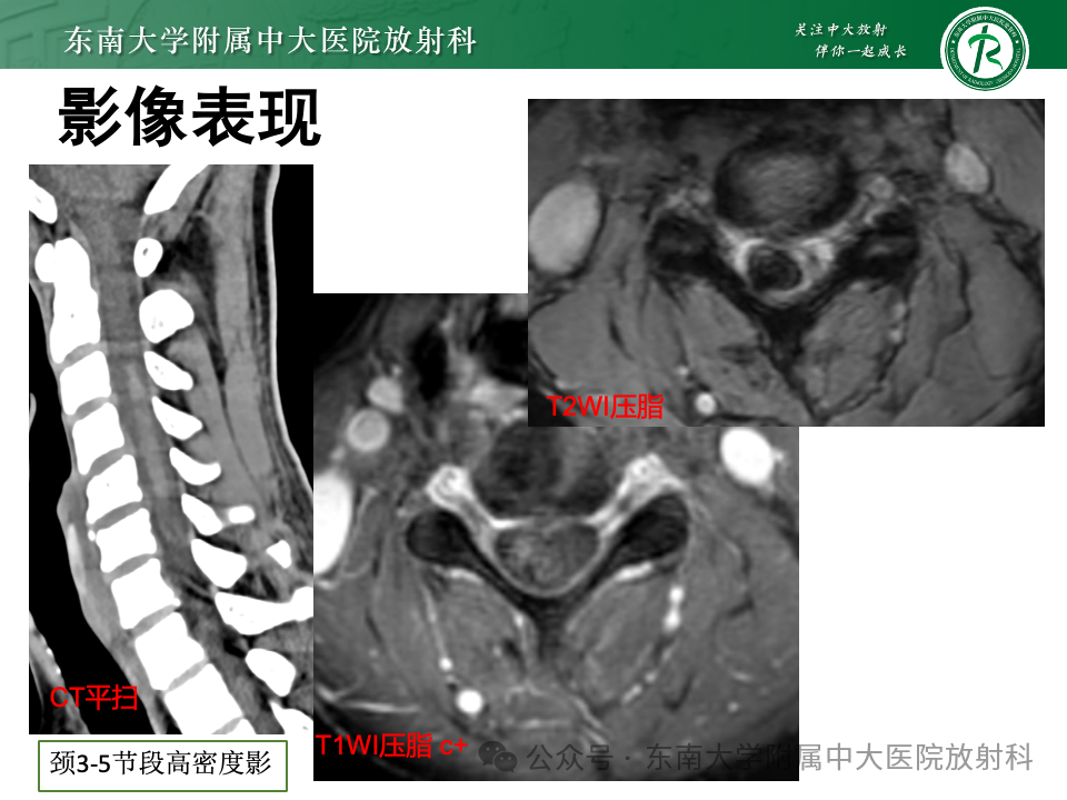 影像PPT - 【PPT】脊髓罕见占位性病变-45 影像PPT - 【PPT】脊髓罕见占位性病变-45