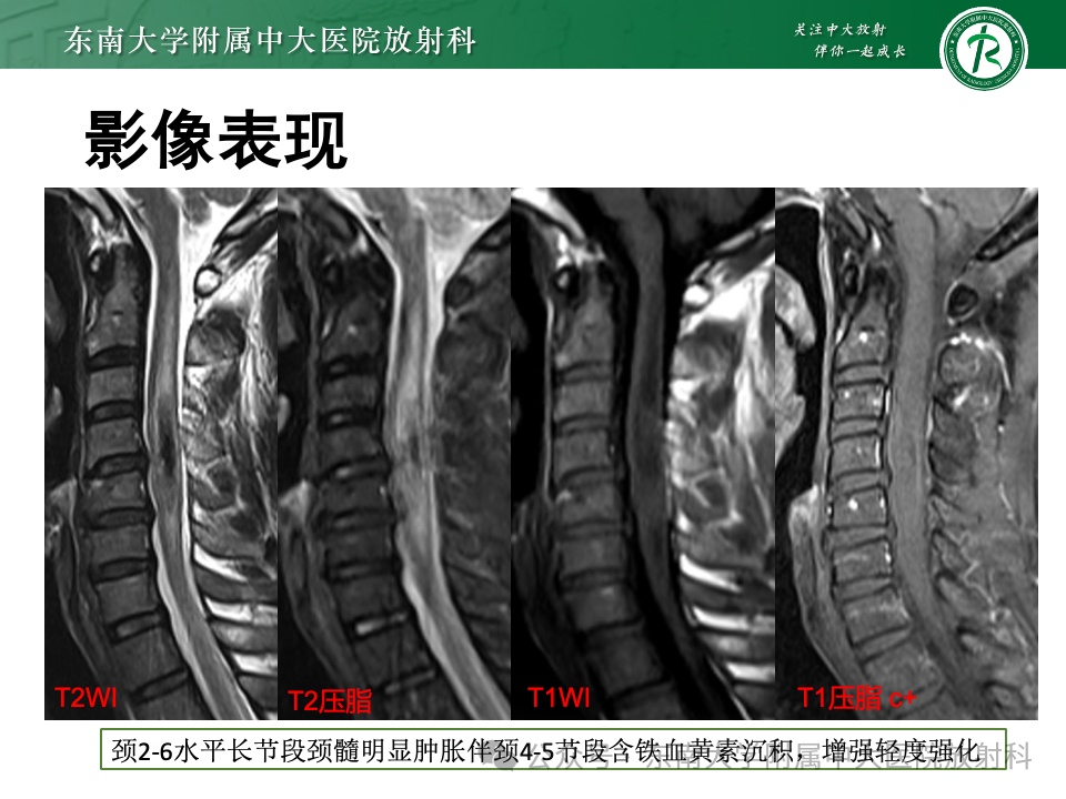 影像PPT - 【PPT】脊髓罕见占位性病变-44 影像PPT - 【PPT】脊髓罕见占位性病变-44