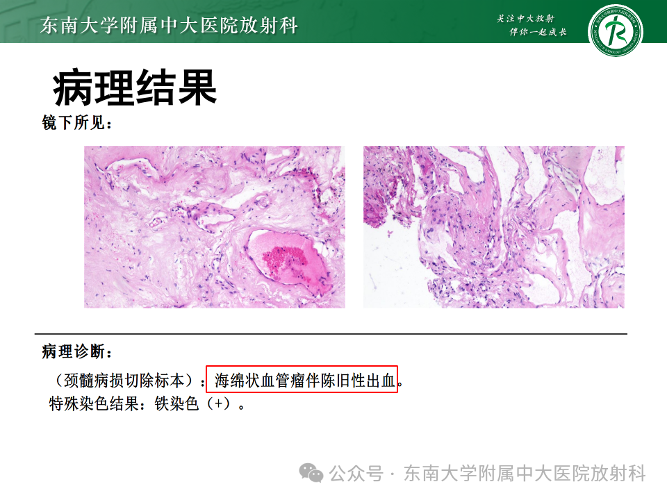 影像PPT - 【PPT】脊髓罕见占位性病变-47 影像PPT - 【PPT】脊髓罕见占位性病变-47