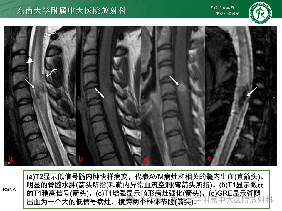 影像PPT - 【PPT】脊髓罕见占位性病变-50 影像PPT - 【PPT】脊髓罕见占位性病变-50