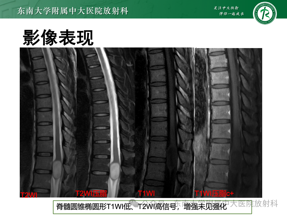影像PPT - 【PPT】脊髓罕见占位性病变-53 影像PPT - 【PPT】脊髓罕见占位性病变-53