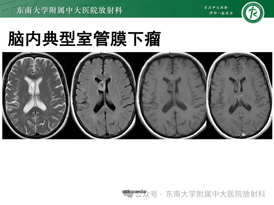 影像PPT - 【PPT】脊髓罕见占位性病变-59 影像PPT - 【PPT】脊髓罕见占位性病变-59
