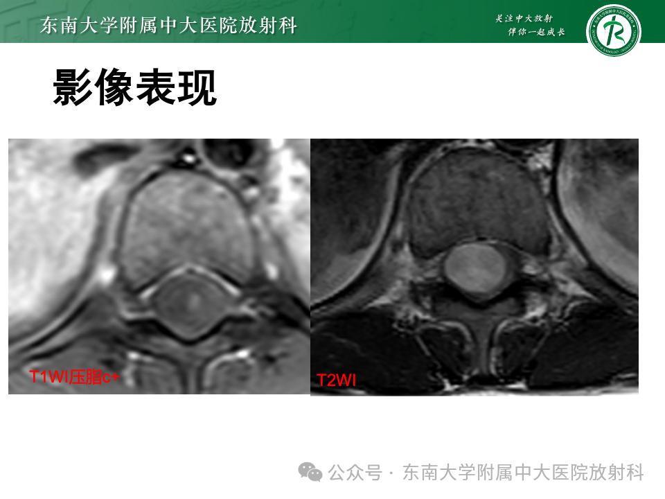 影像PPT - 【PPT】脊髓罕见占位性病变-54 影像PPT - 【PPT】脊髓罕见占位性病变-54