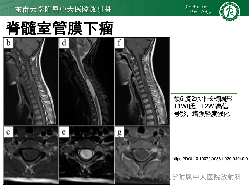 影像PPT - 【PPT】脊髓罕见占位性病变-60 影像PPT - 【PPT】脊髓罕见占位性病变-60