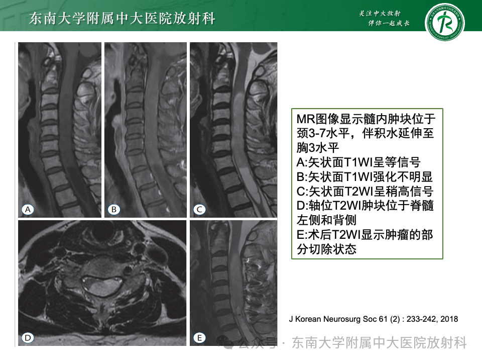 影像PPT - 【PPT】脊髓罕见占位性病变-61 影像PPT - 【PPT】脊髓罕见占位性病变-61