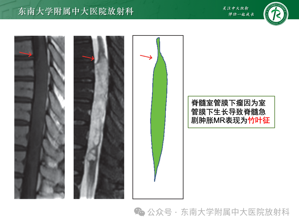 影像PPT - 【PPT】脊髓罕见占位性病变-62 影像PPT - 【PPT】脊髓罕见占位性病变-62