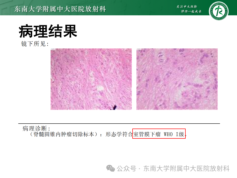 影像PPT - 【PPT】脊髓罕见占位性病变-56 影像PPT - 【PPT】脊髓罕见占位性病变-56