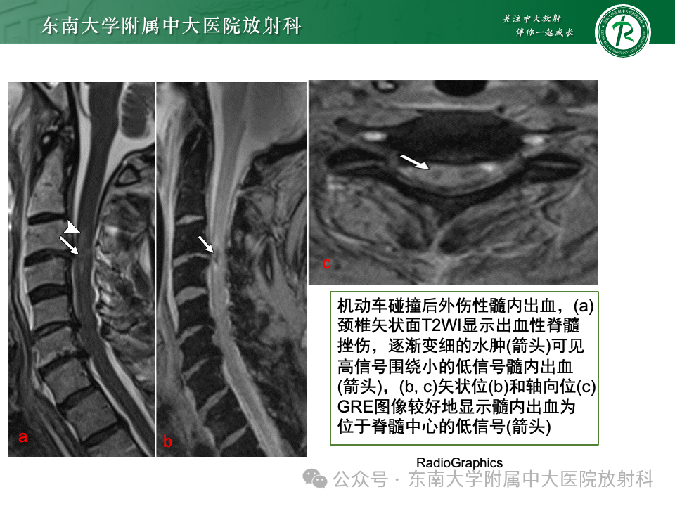 影像PPT - 【PPT】脊髓罕见占位性病变-2 影像PPT - 【PPT】脊髓罕见占位性病变-2