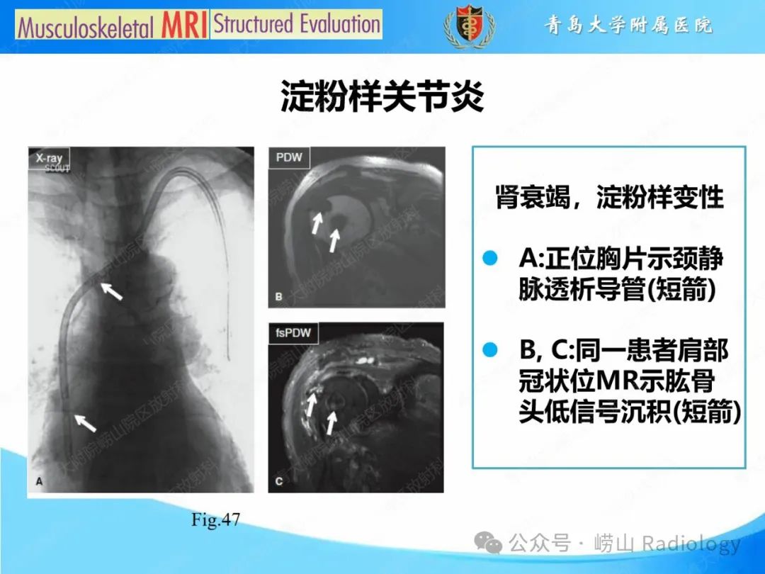 影像PPT - 【PPT】感染和炎症/关节炎-5