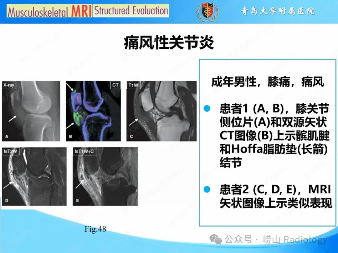 影像PPT - 【PPT】感染和炎症/关节炎-7