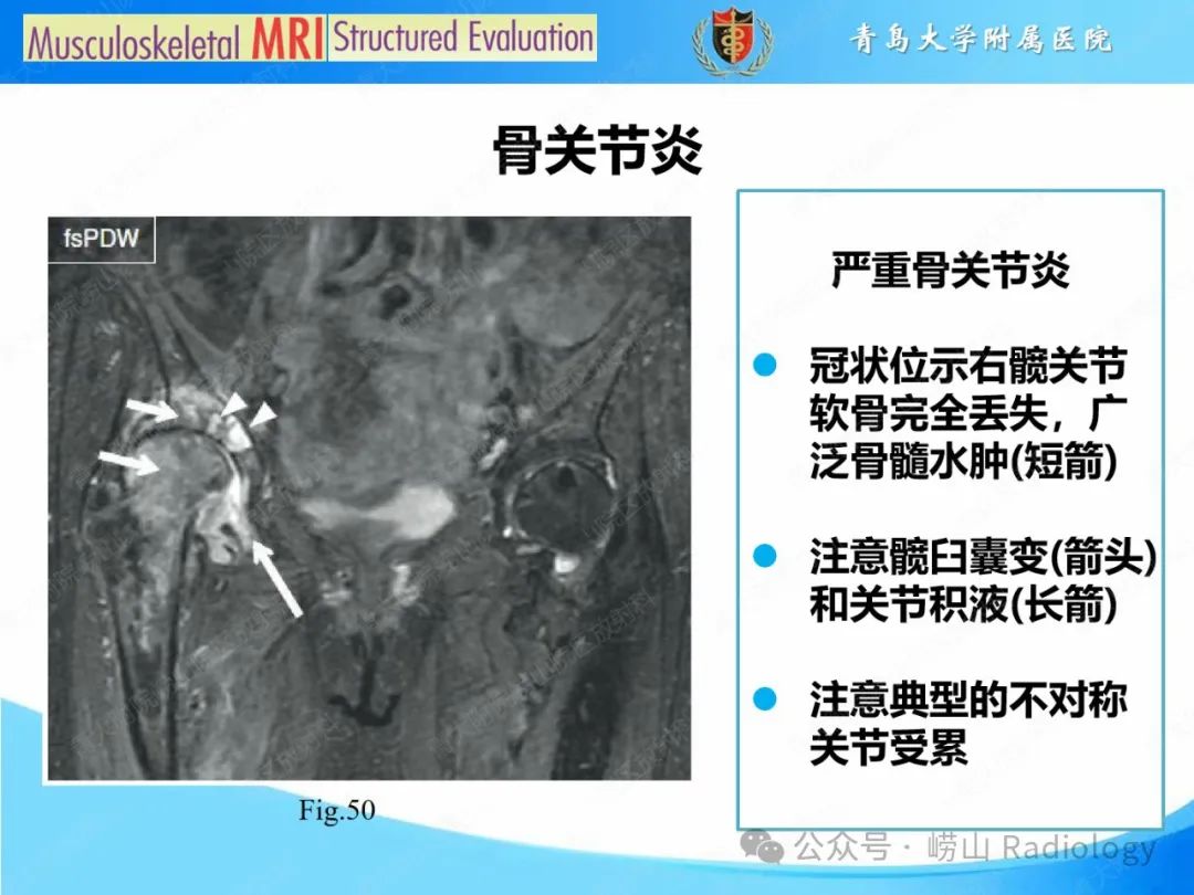 影像PPT - 【PPT】感染和炎症/关节炎-10
